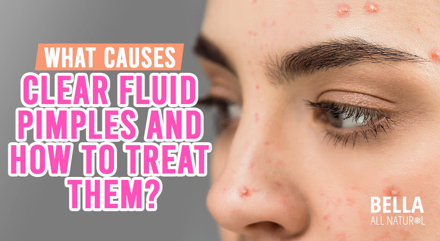 what-causes-clear-fluid-pimples-and-how-to-treat-them-bella-all-natural